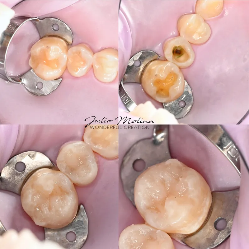 Secuencia clínica: caries removida y muela restaurada conservando el diente natural